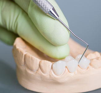 Model of Dental Bridges