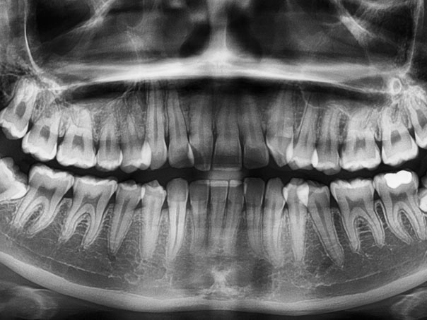 Dental Xray