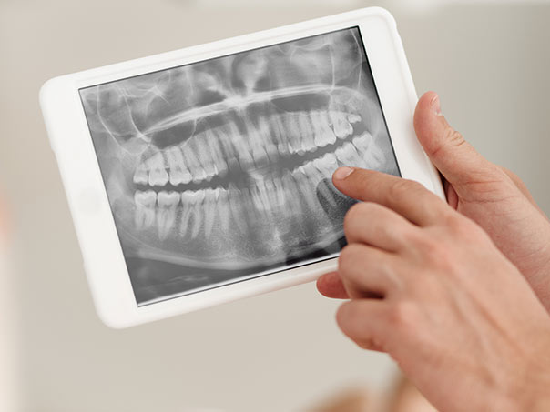 Xray on Ipad of Teeth