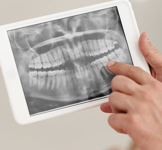 Xray of Jaw