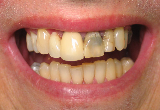 Before Composite Veneer treatment at Bayview Dental