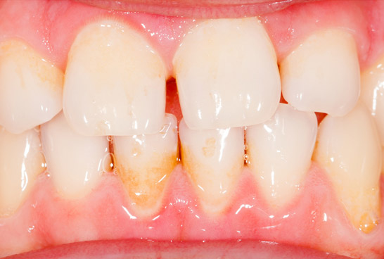 gum disease before