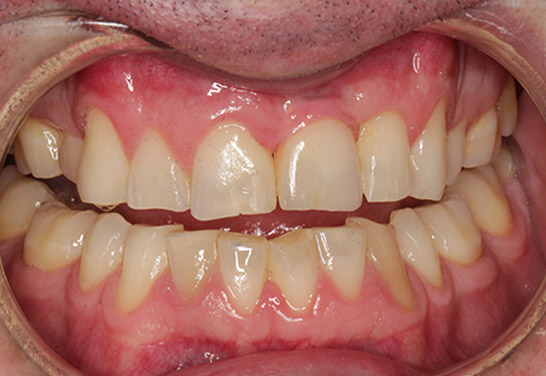 After Dental Implants at Bayview Dental