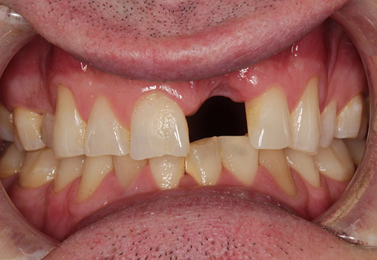 Before Dental Implants at Bayview Dental