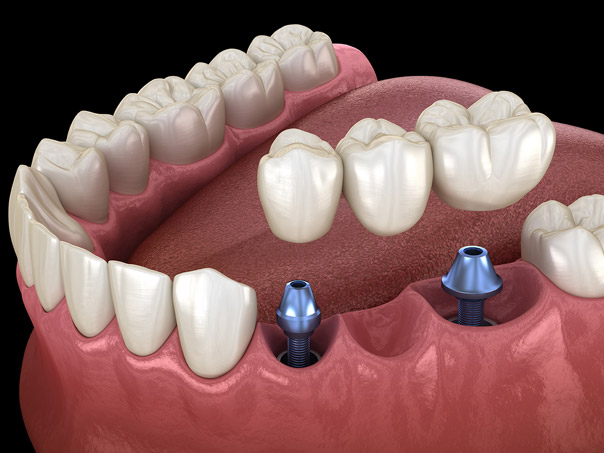 implant supported bridge