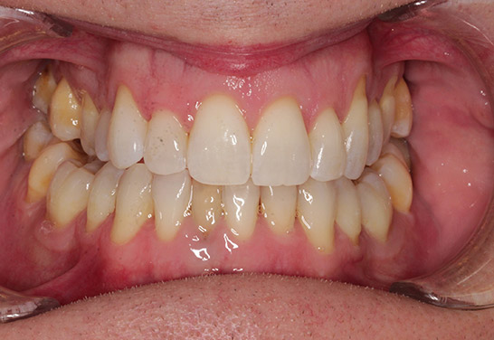 After Invisalign at Bayview Dental