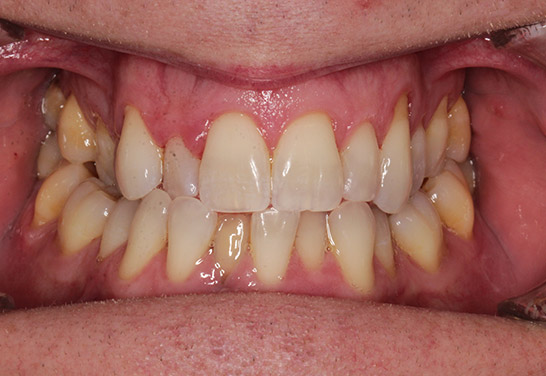 Before Invisalign at Bayview Dental