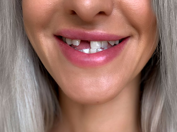 missing-tooth-grey-hair-dental implants