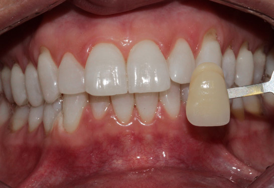 Teeth whitening ay Bayview Dental