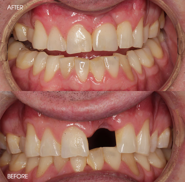 Before and After Dental Implants from Bayview Dental Claremont, Perth
