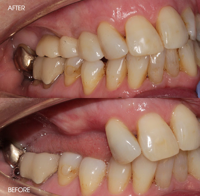 Before and After Dental Implants from Bayview Dental Claremont, Perth