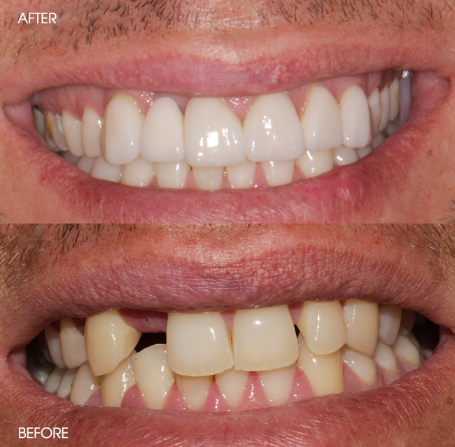 Before and After Dental Implants from Bayview Dental Claremont, Perth