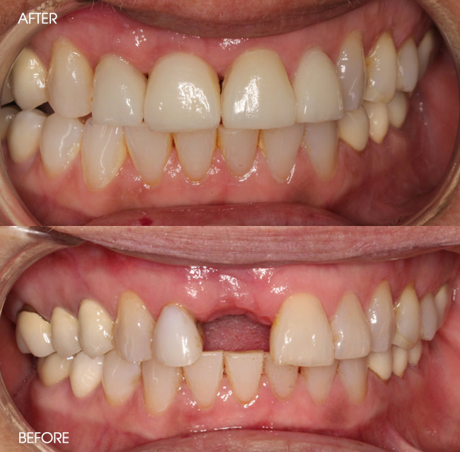Before and After Dental Implants from Bayview Dental Claremont, Perth