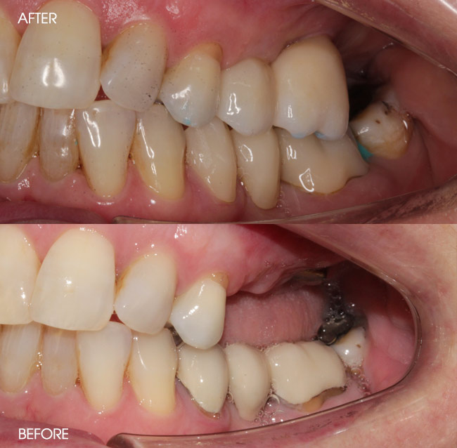 Before and After Dental Implants from Bayview Dental Claremont, Perth