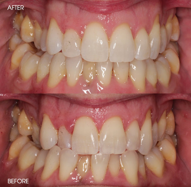 Before and After Invisalign from Bayview Dental Claremont, Perth