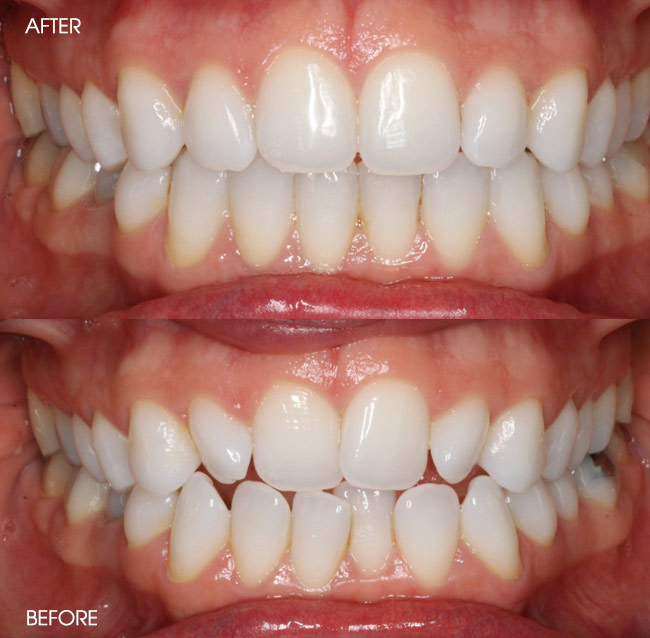 Before and After Invisalign from Bayview Dental Claremont, Perth