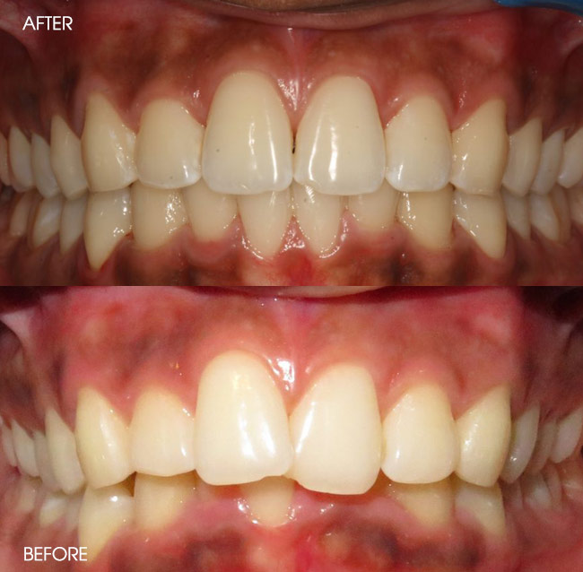 Before and After Invisalign from Bayview Dental Claremont, Perth