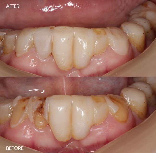 Before and After Porcelain Veneers from Bayview Dental Claremont, Perth