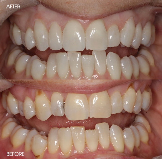 Before and After Porcelain Veneers from Bayview Dental Claremont, Perth