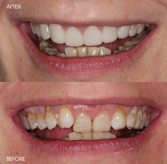 Before and After Porcelain Veneers from Bayview Dental Claremont, Perth