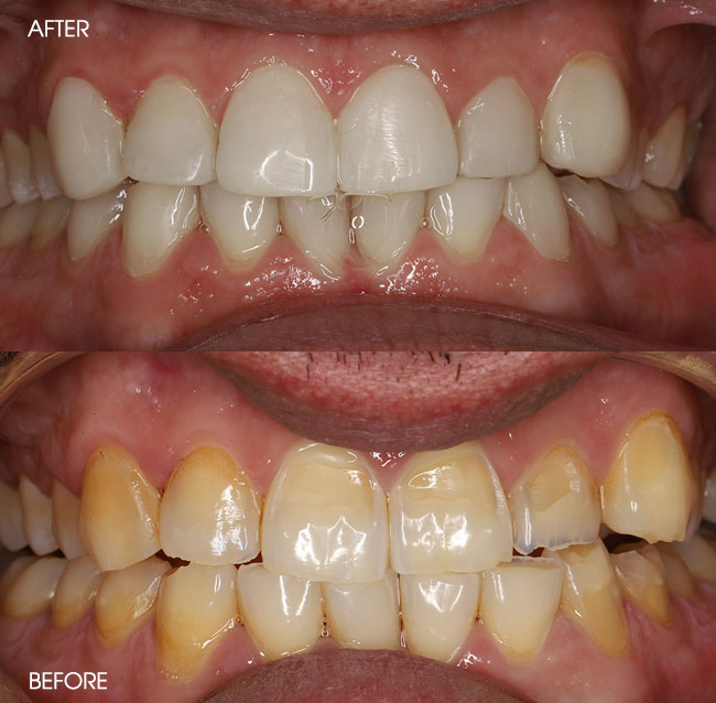 Before and After Porcelain Veneers from Bayview Dental Claremont, Perth