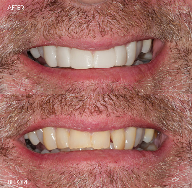 Before and After Porcelain Veneers from Bayview Dental Claremont, Perth