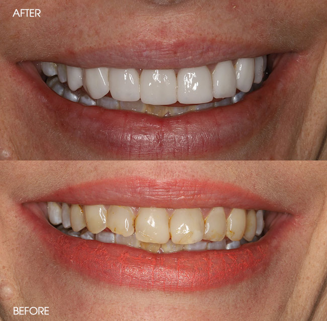 Before and After Porcelain Veneers from Bayview Dental Claremont, Perth