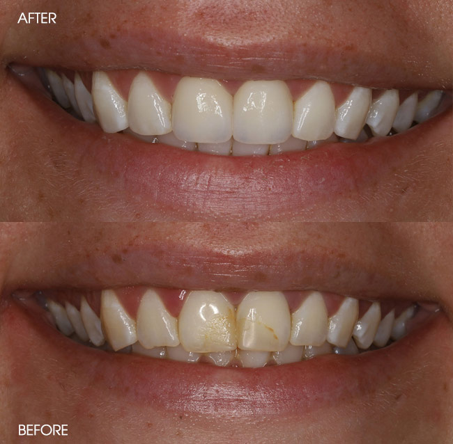 Before and After Porcelain Veneers from Bayview Dental Claremont, Perth