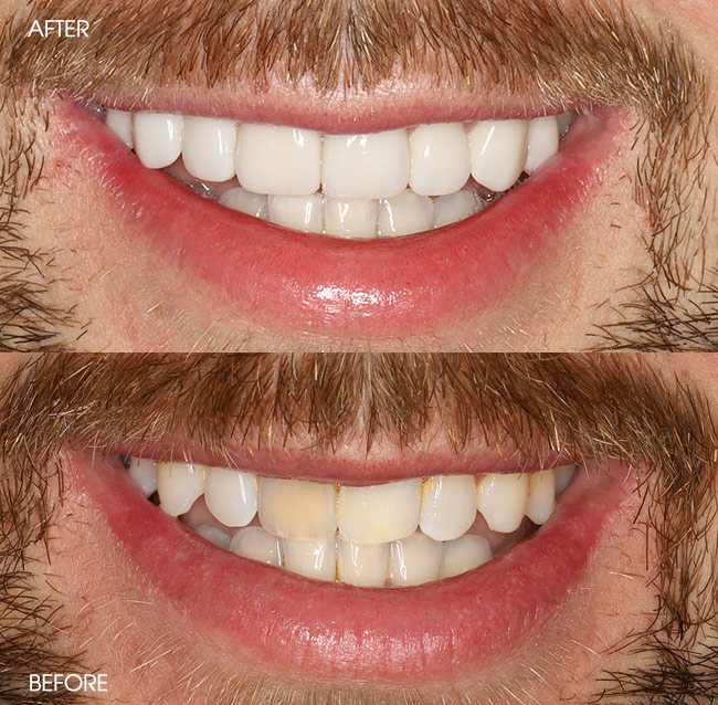 Before and After Porcelain Veneers from Bayview Dental Claremont, Perth