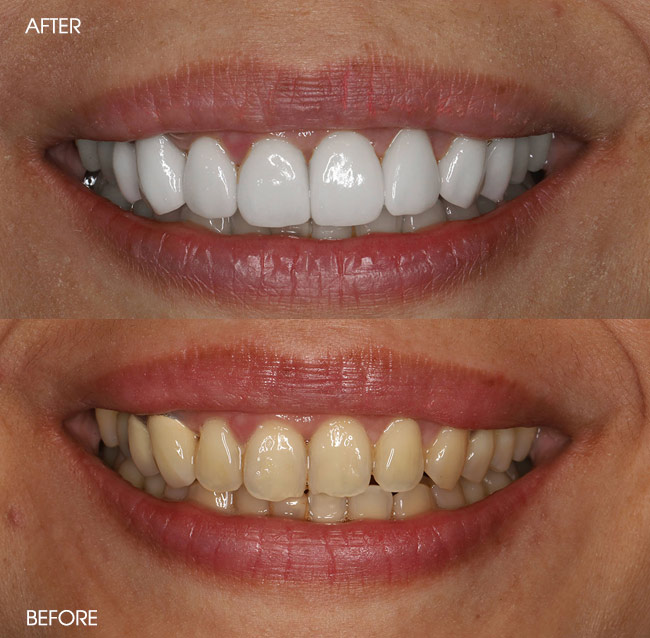 Before and After Porcelain Veneers from Bayview Dental Claremont, Perth