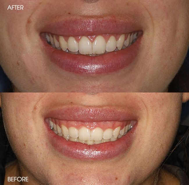 Before and After Porcelain Veneers from Bayview Dental Claremont, Perth