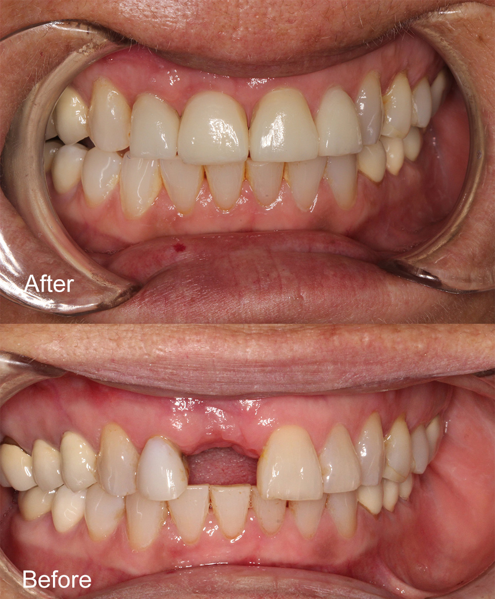 Before and After Dental Implant from Bayview Dental Claremont, Perth