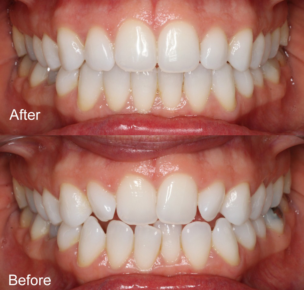 Before and After Invisalign from Bayview Dental Claremont, Perth