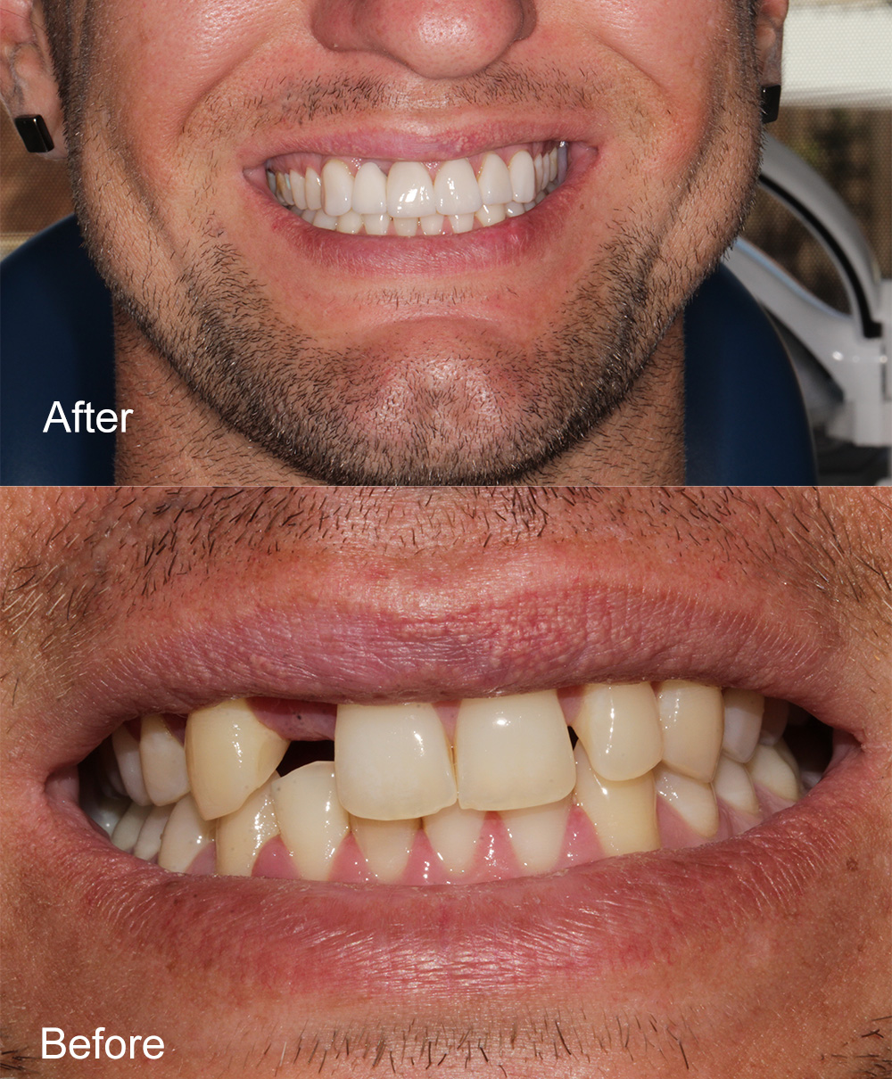 Before and After Dental Implant from Bayview Dental Claremont, Perth