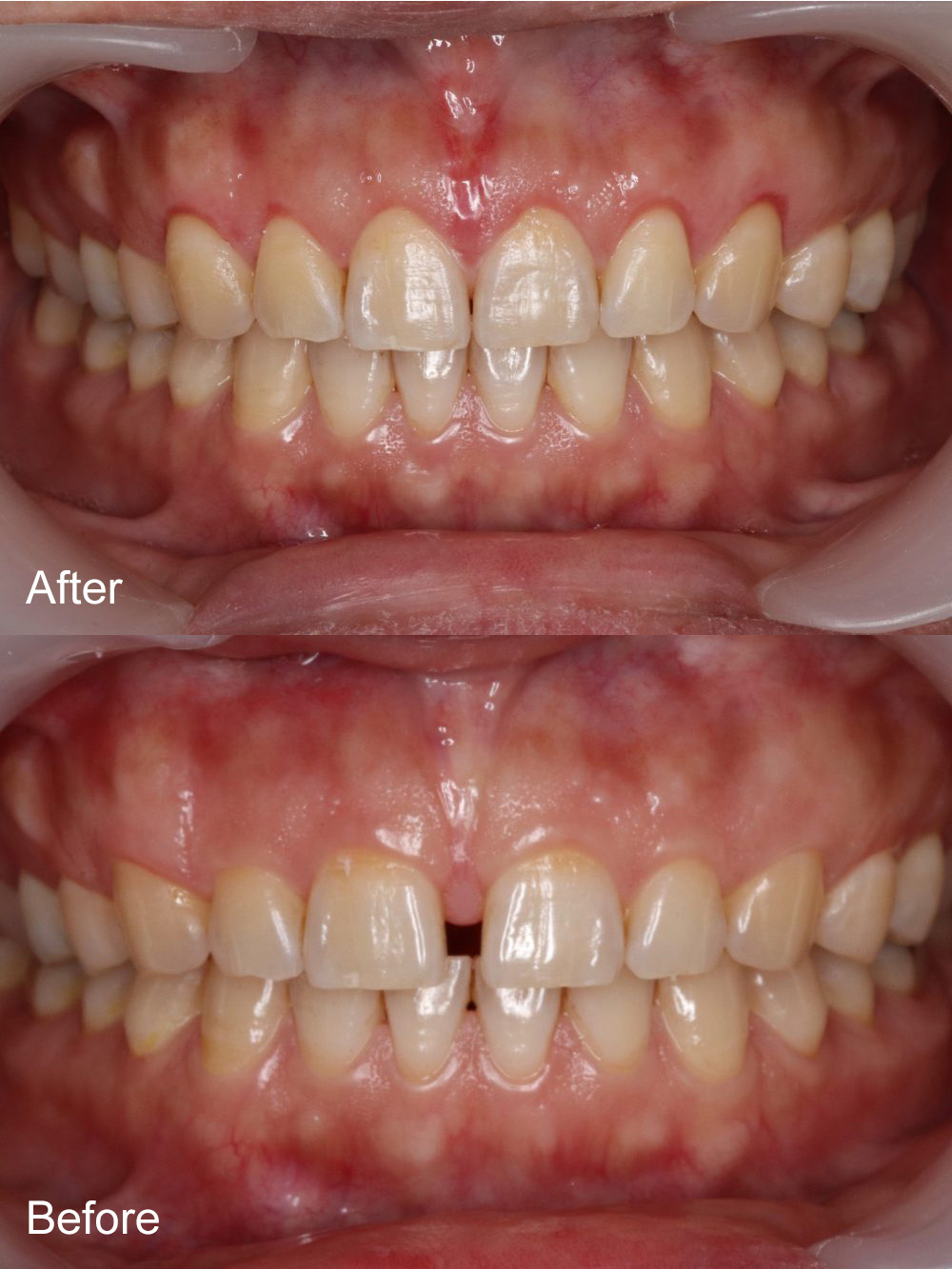 Before and After Invisalign from Bayview Dental Claremont, Perth