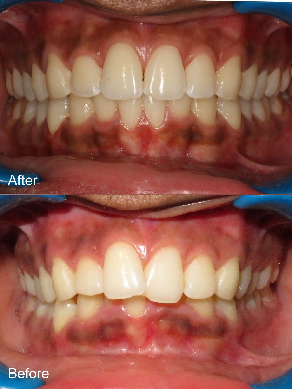 Before and After Invisalign from Bayview Dental Claremont, Perth