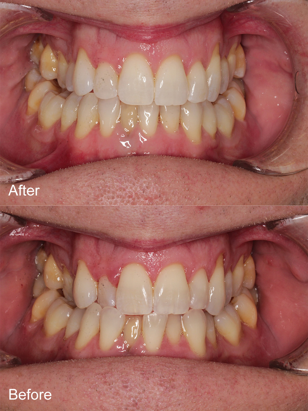 Before and After Invisalign from Bayview Dental Claremont, Perth