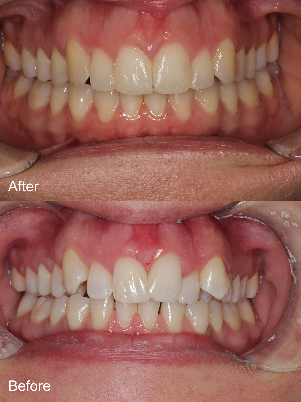 Before and After Invisalign from Bayview Dental Claremont, Perth
