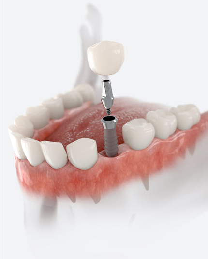 dental implants dalkeith